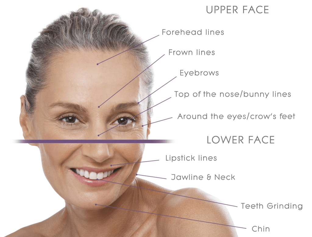 botox injection sites